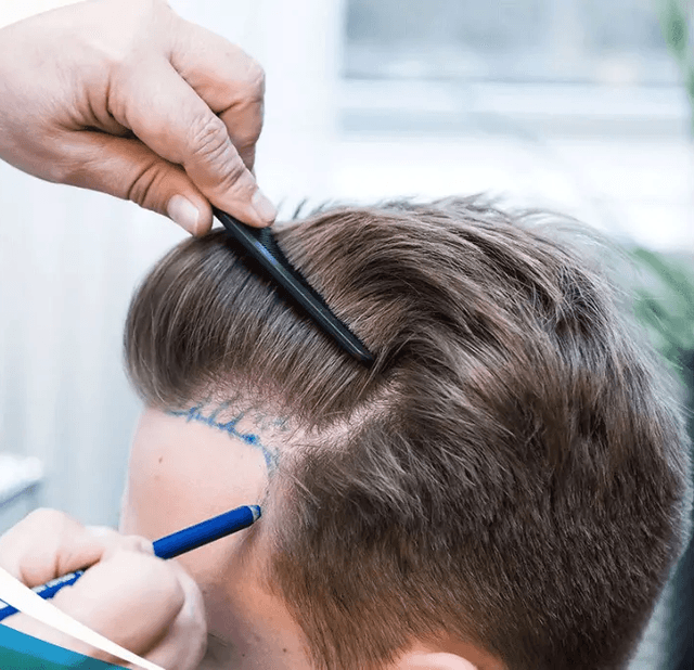 Hair Transplant