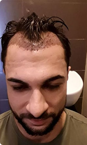 Before Treatment